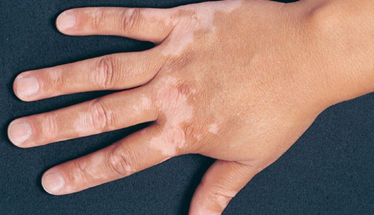 ত্বকের সাদায় লজ্জা, চিকিৎসায় মুক্তি