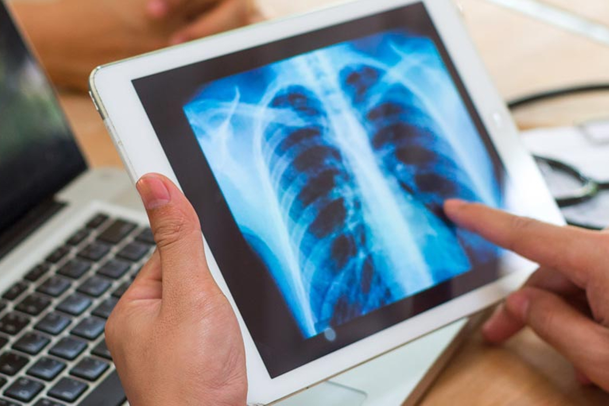 নয়া স্ক্যান পদ্ধতিতে বোঝা যাবে ফুসফুসের হাল