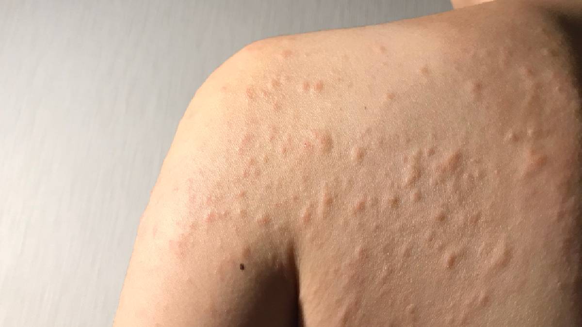 ডাস্ট অ্যালার্জিতে ভুগছেন, জেনে নিন কীভাবে নিয়ন্ত্রণে রাখবেন অ্যালার্জি