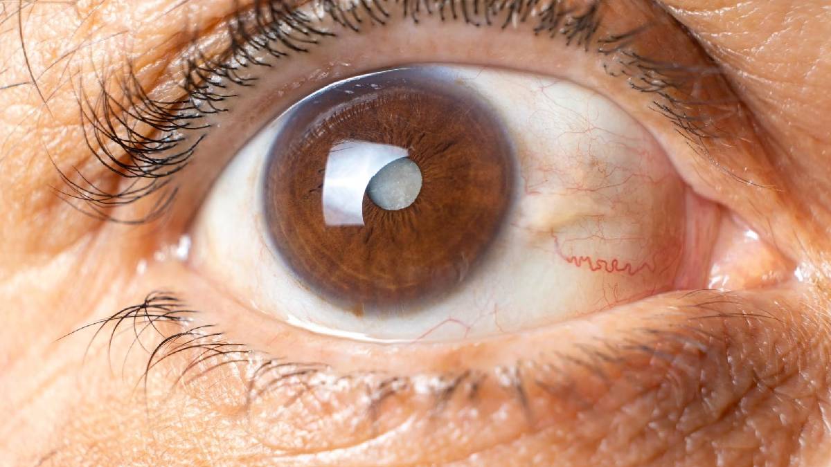 গ্লকোমায় দৃষ্টিশক্তি হারানোর ঝুঁকি কমাবে ‘ডায়োড লেজার সাইক্লোফোটোকোঅ্যাগুলেশন’  থেরাপি