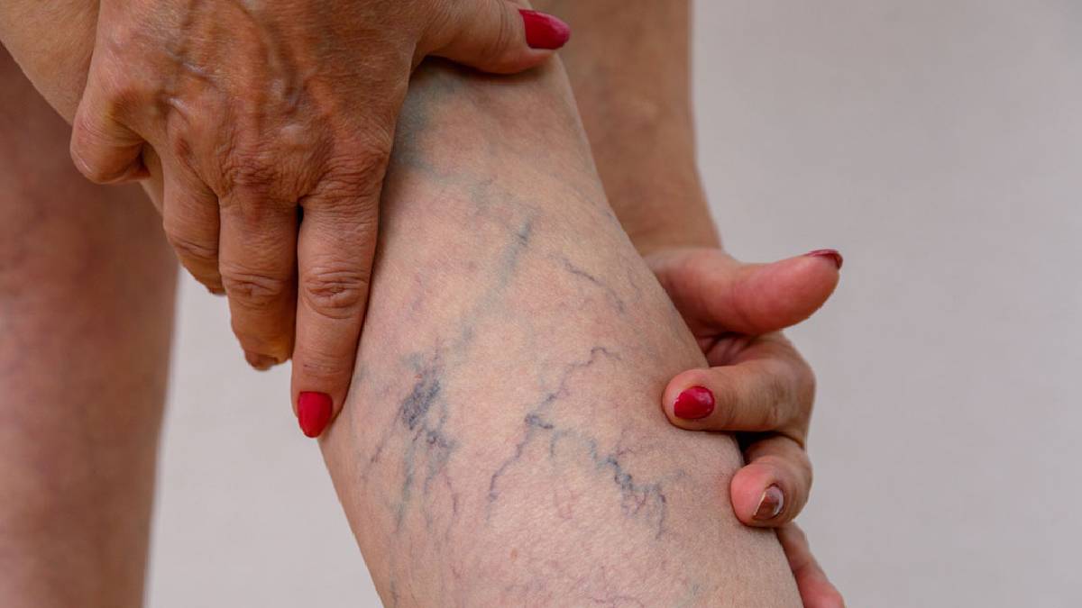 পায়ের রোগ ভেরিকোজ ভেইন কী? উপসর্গ, প্রতিকার