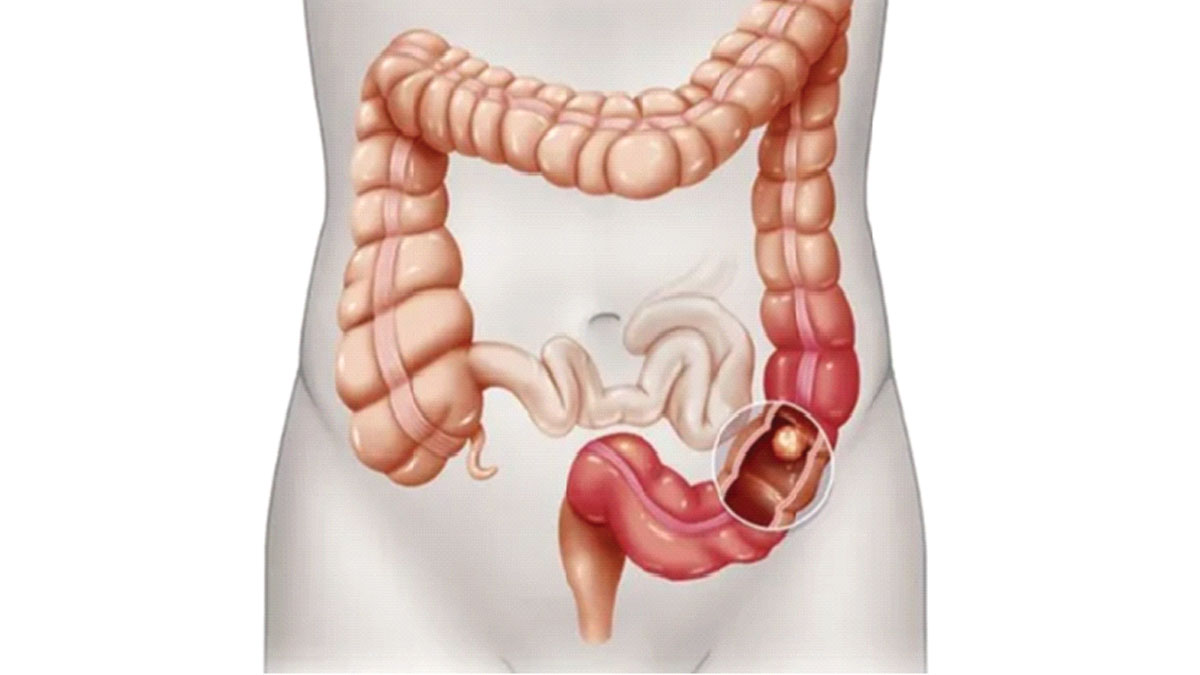 ডানদিকের কোলনে নীরব ক্যান্সারের সম্ভাবনা