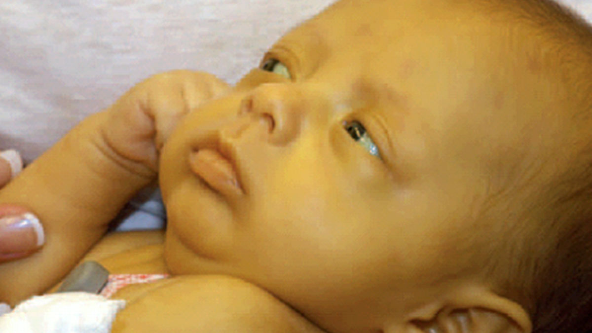 নবজাতকের জন্ডিস: সাধারণ হলেও অবহেলা নয়, পরামর্শ চিকিৎসকদের