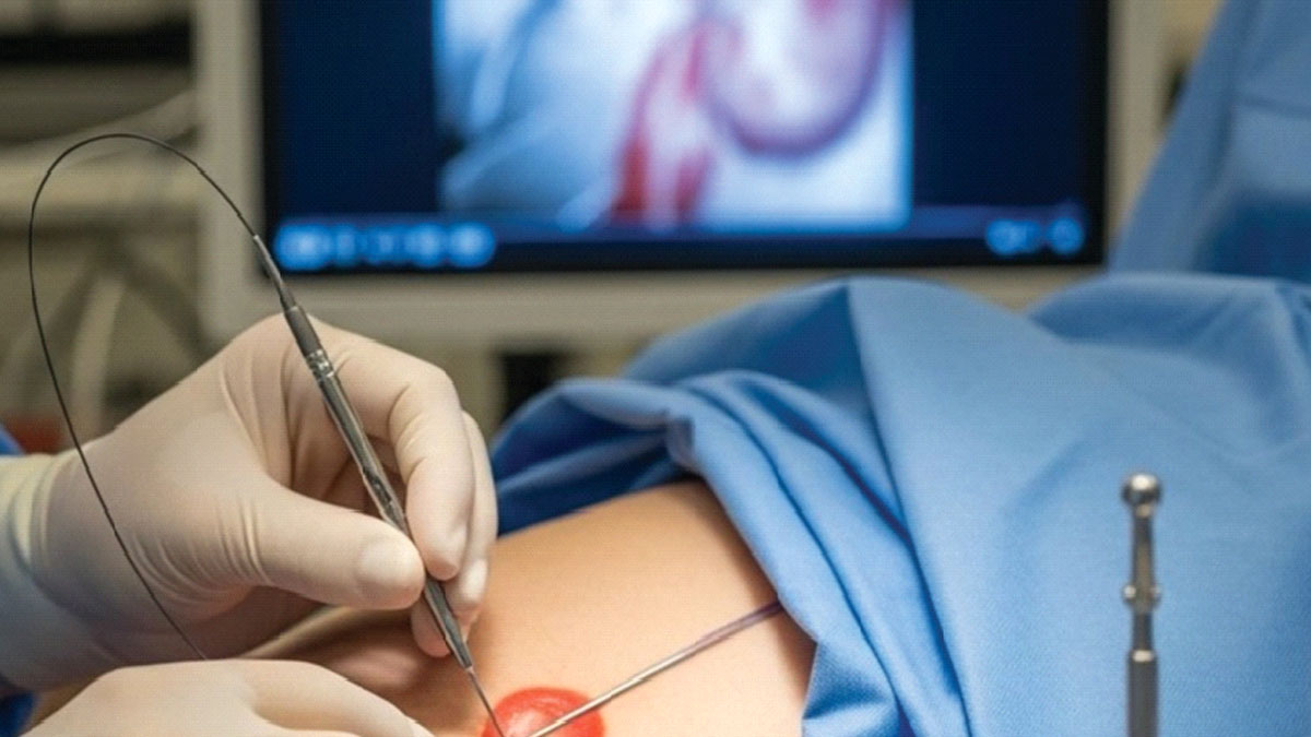 ​জটিল কিডনি সমস্যার সফল অস্ত্রোপচারে প্রাণ বাঁচল রোগীর